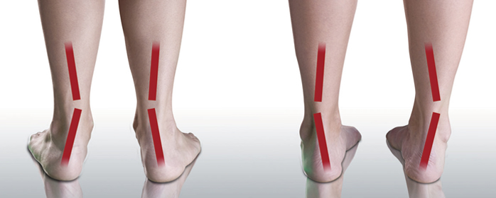 足の歪みの原因と症状｜接骨院（整骨院）による施術とインソールの活用で再発を防ぐ